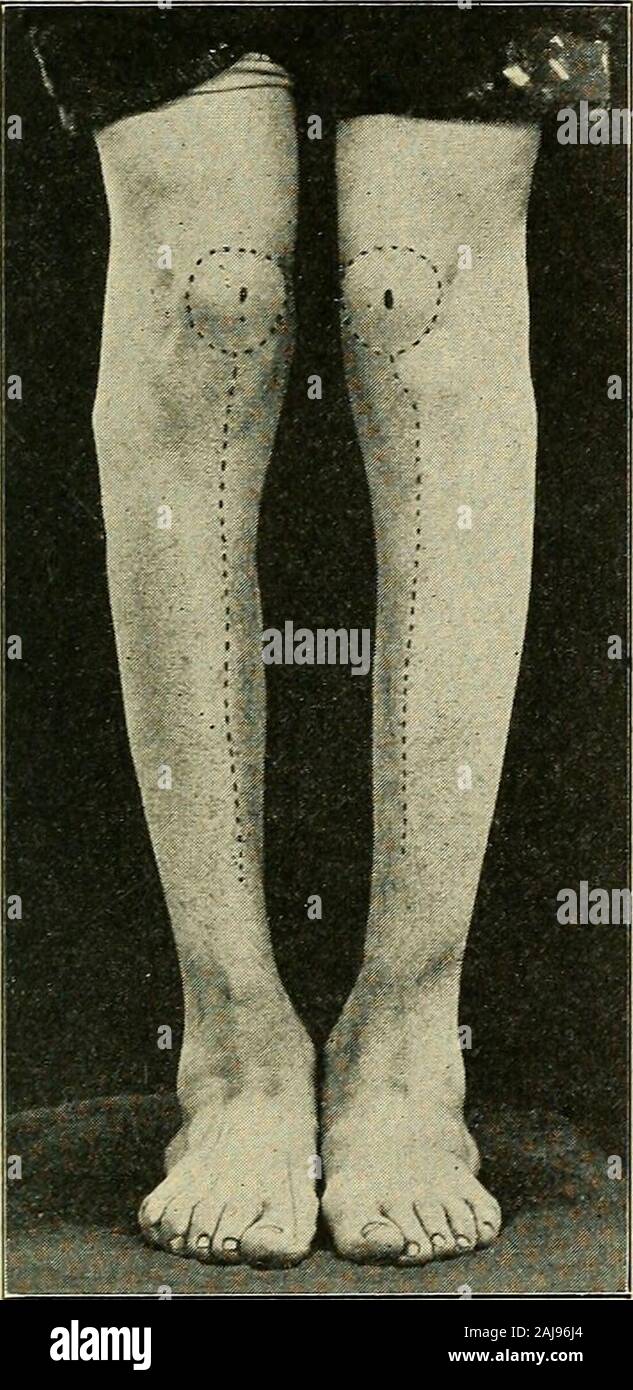 A treatise on orthopedic surgery . than the front of the foot; the heel projects, the externalmalleolus is depressed and carried forward by the rotation ofthe leg, and is much less prominent than normal; the internalmalleolus is more prominent, and with the astragalus it over-hangs the bearing surface of the sole. The entire mechanism isout of gear; its motion is, therefore, very much restricted. Itis manifestly impossible for the patient to adduct the forefoot—that is, to turn it inward alx)ut the head of the displaced astrag-alus. Plantar flexion is also much limited, because of the per- DIS Stock Photo