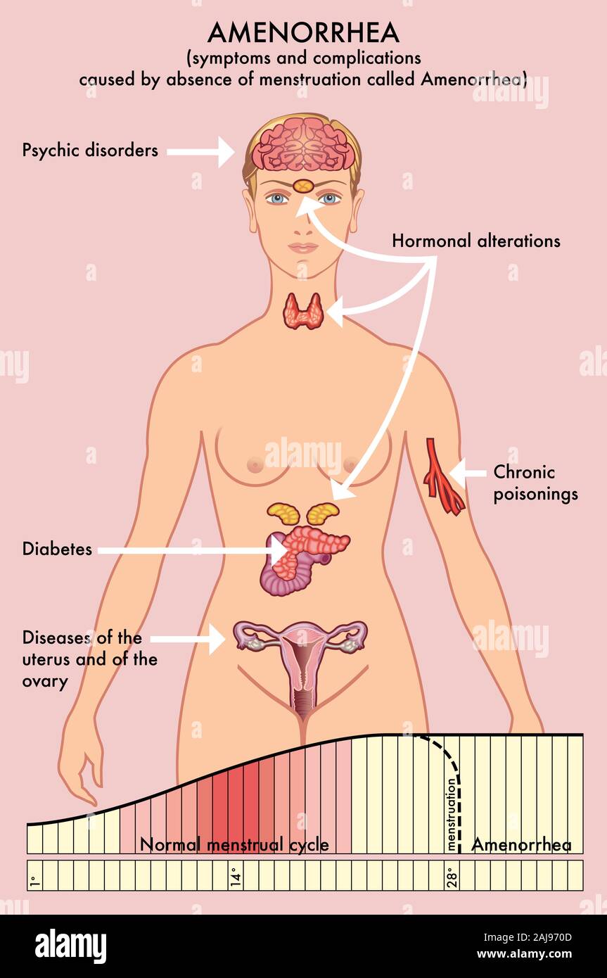 Medical diagram of symptoms and complications caused by absence of menstruation called Amenorrhea. Stock Photo