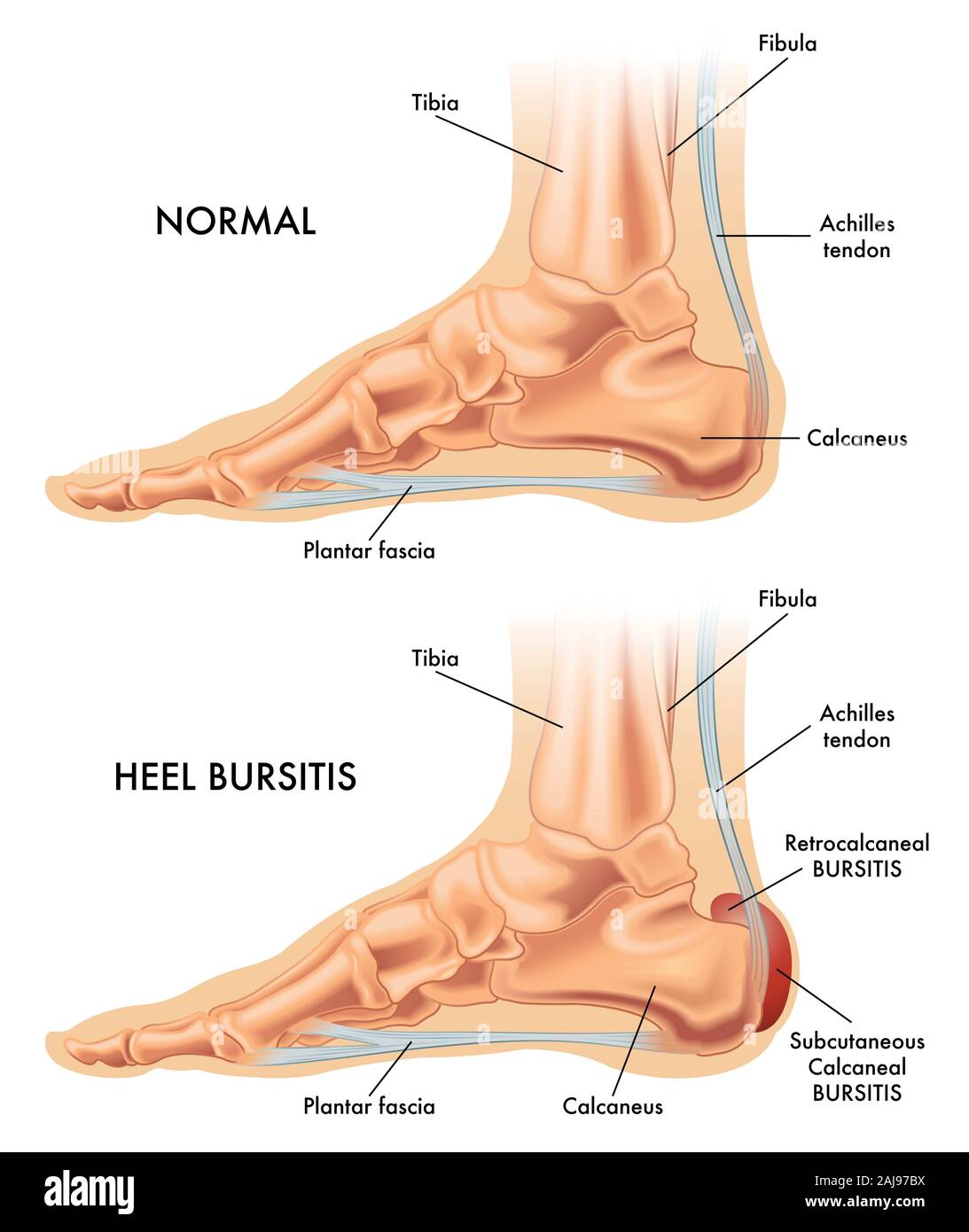 A medical illustration of a healthy foot and a foot affected by heel bursitis. Stock Photo