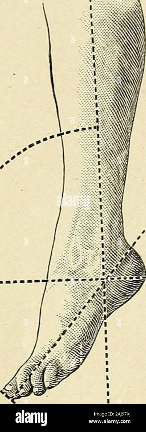 A treatise on orthopedic surgery . Voluntary dorsal flexion. Voluntary plantar flexion. In tliese attitudes ttie astragalus moves with the foot upon the leg bones, ascontrasted with adduction and abduction, in which the centre of motion is belowthe astragalus. upon the heels. Such a walk is necessarily jarring and ungrace-ful, and if it is-not the result of weakness and deformity it pre-disposes to them because of the disuse of proper function. One means of making the leverage function difficult is thecustom of turning the feet outward. Outward rotation of thelimbs is normal in the passive att Stock Photo