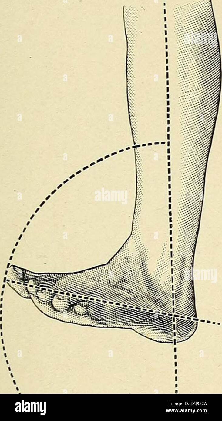 A Treatise On Orthopedic Surgery Erage Function The Foot As One Foot Is Advanced It First Bears Weight Momen Tarily On The Heel Then Upon Its Outer Border The Heel Is Thenraised And