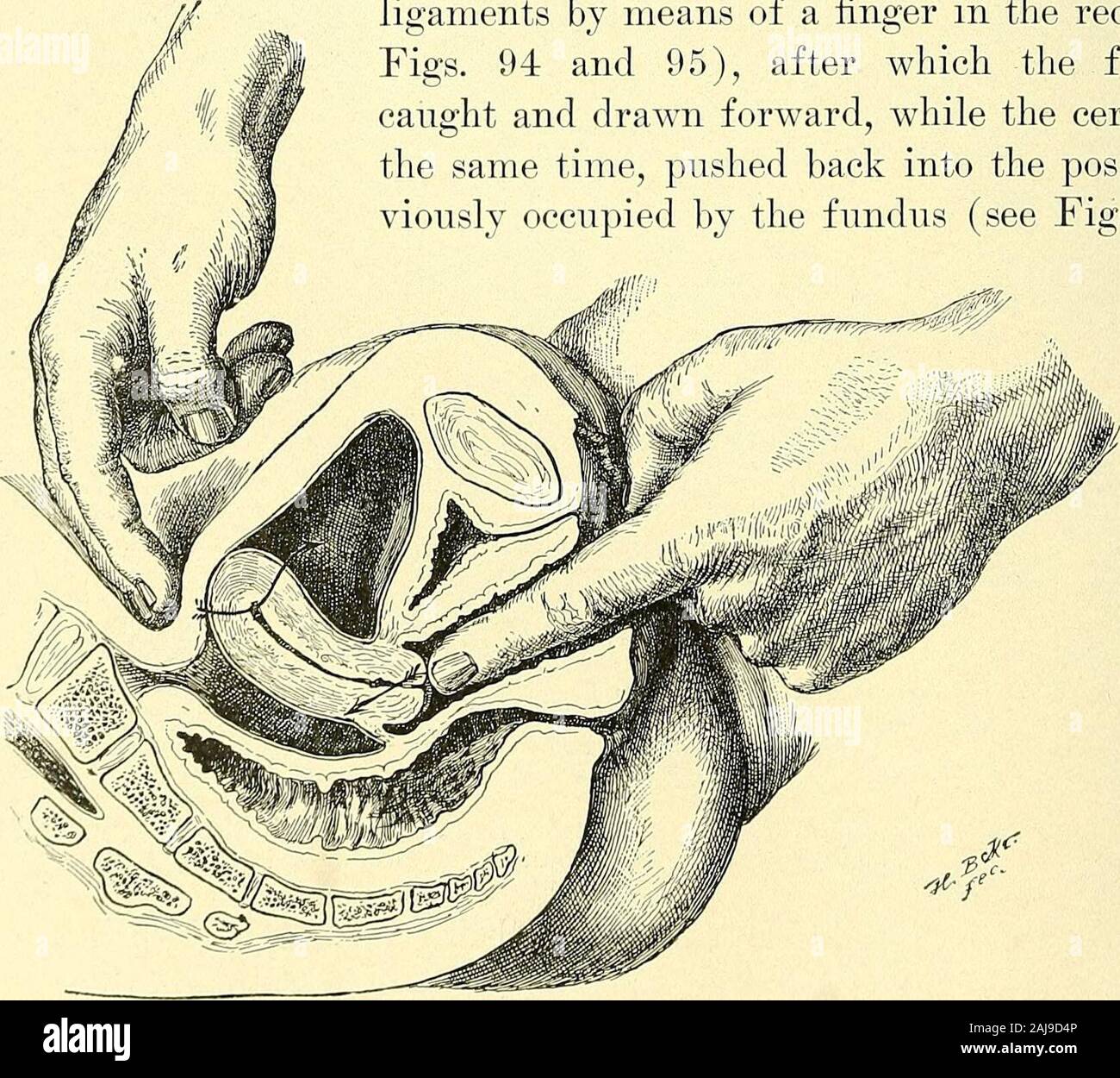 Operative Gynecology Fig 95 The Forceps Are Then Used To Carry The Cervixwell Back Into The Pelvis Fig 96 The Flexion Being In This Manner Reduced The Fundus Is Within Reach Of Operative Gynecology Fig 95 The Forceps Are Then Used To Carry The Cervixwell Back Into The Pelvis Fig 96 The Flexion Being In This Manner Reduced The Fundus Is Within Reach Of