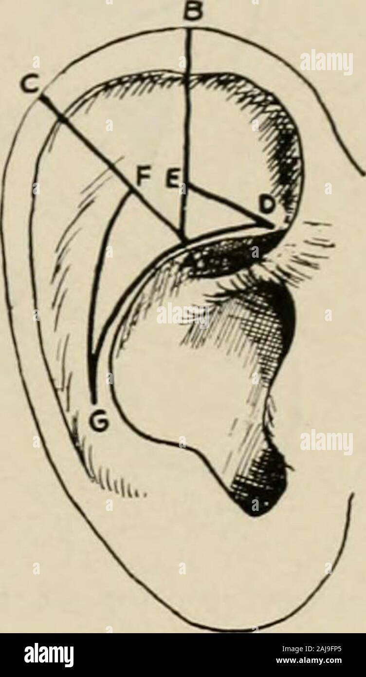 Plastic surgery; its principles and practice . Fig. 406. Fig. 407. Fig. 406.—Operation for macrotia (Cockeril.)—The shaded areas indicate the portionsexcised from the full thickness of the ear. When sutured, C is brought to C, A to A,B to B, and D to D. Fig. 407.—Operation for macrotia (Cheyne and Biirghard).—A V-shaped piece of the fullthickness of the ear CAB is excised from the upper and outer part of the auricle. The baseof the wedge is at the outer margin of the helix, and the apex through the antihelix. Corre-sponding to the margin of the antihelix a curved incision GAD. is made through Stock Photo