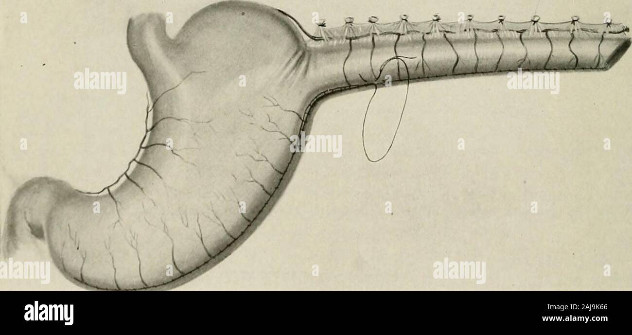 Surgical treatment; a practical treatise on the therapy of surgical diseases for the use of practitioners and students of surgery . Fig. i 141.—Gastroesophagoplasty. Third Stage.The greater curvature of the stomach ? has been converted into a tube. Two rows ofsutures are used to close the stomach. The clamps should be removed as soon as possible. them. To reach the diaphragm nearer its center, the transpleural rootmust be chosen; this is through the excision of costal cartilages in the mam-mary line.. Fig. i 142.—Gastroesophagoplasty. Fourth Stage.Tube completed and ready for transplantation. Stock Photo