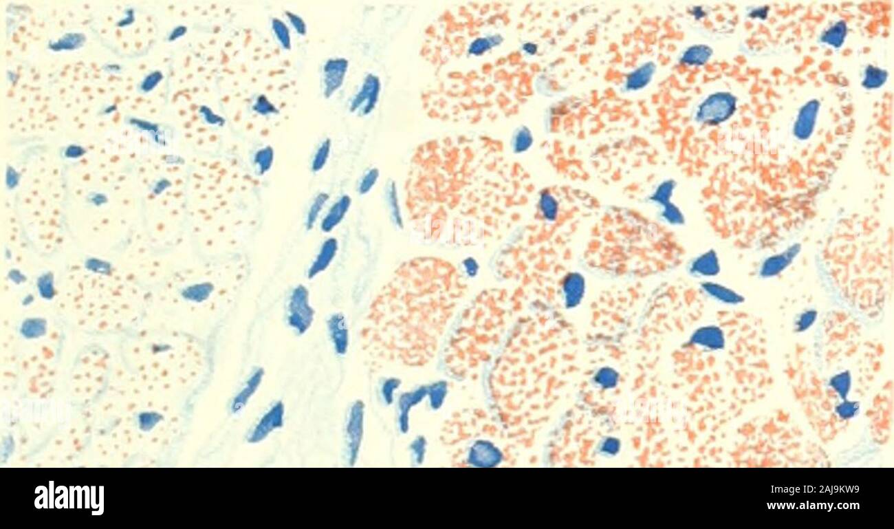 The American journal of anatomy . bers is large; L, light fiber; D, dark fiber. X 500. 5 Longitudinal section from same preparation as in figure 4; L, light fibers;D, dark fibers (animal 46, table 3). X 500. 6 From the interventricular septum of a cat killed 17 hours after receivinga large meal of pork fat (animal 84, table 5). Very large amount of fat in cardiacfibers, C; moderate or large amount in Purkinje fibers of the left limb of bundle ofHis, P. X500. 7 From the interventricular septum of an eight months human fetus (animal141, table 8). There is a moderate amount of fat in the cardiac Stock Photo