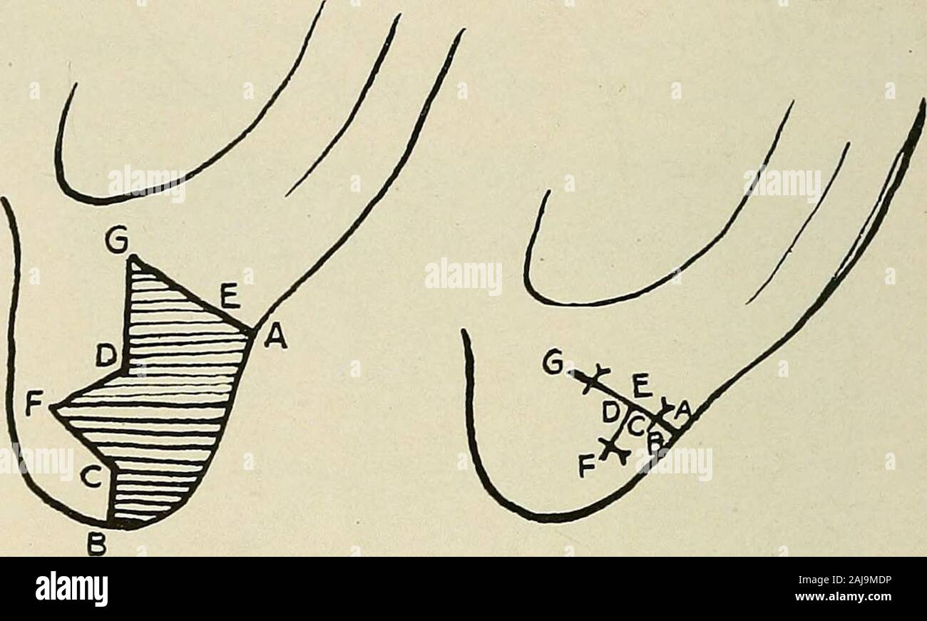 Plastic surgery; its principles and practice . Fig. 399.—Greens operation for correcting a lobular defect {Kolle).—i. The dottedline D shows the incision for removing the cicatricial skin. The line AP marks out theflap with a thin marginal tip B, which is to be used to obliterate the notch. 2. The scaris excised and the edges are approximated. Then H is sutured to A, F to G. The thin tipB being sutured to a denuded surface along the margin. 404 PLASTIC SURGERY. Fig. 400.—Operation for correcting an abnormally long lobule (J. Joseph).—i. Anarea including the full thickness of the lobule, shaped Stock Photo