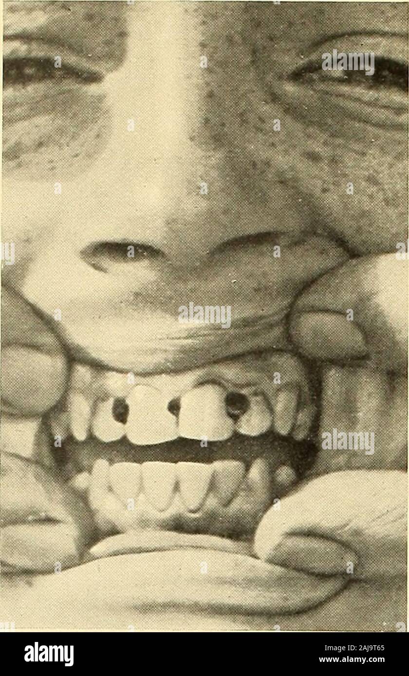 Annual reports.. . the year by the Depart-ments treatment scheme was as follows:— The Travelling Hospital treated ...The six Travelling Dental Clinics treated .The Metropolitan Dental Clinic treated .The Travelling Ophthalmic Clinic treated 1918. 1919. 2,090 2,454 2,033 11,290 3,893 2,462 3,082 102 Total number treated by the Officers of the School Medical Service 21,098 16,374 Note —In 1918 tho above clinics treated 21,098 childien ; in 1919, 10,374 (travelling ophalmieclinic discontinued 31st Januaiy, 1919). 5,411 (1918), 4,9S0 (1919) [see note at foot of table 2], we.echildren who had been Stock Photo