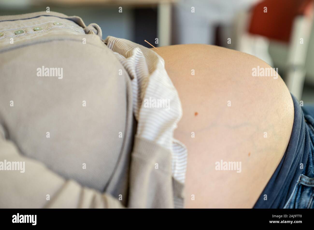 Acupuncture pour femmes enceintes Stock Photo