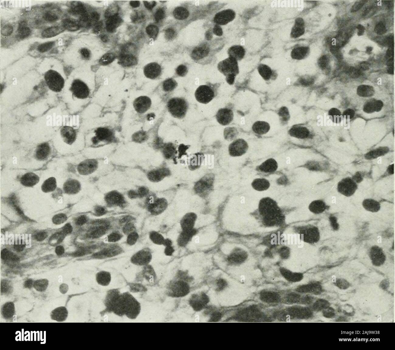 Annals of surgery . Fig. 3.—Case XI: Microphotograph of a section from metastatic hypernepliroma in upperend of humerus. Oval polygonal cells—preservation of rim of cytoplasm, deeply staining nucleus,perinuclear lightly staining spaces. Microphotograph by Mr. Brown, M. G. H. Laboratory.. Fig. 4.—Case XI : Microphotograph of a section from metastatic hypernephroma in upper end ofhumerus. Higher power than in previous plate, No. 3. BONE METASTASES OF HYPERNEPHROMA. 853 September, 1905. J. J. A., a man thirty-four years old. Hasalways been well and strong. For eleven months he has had painand dis Stock Photo
