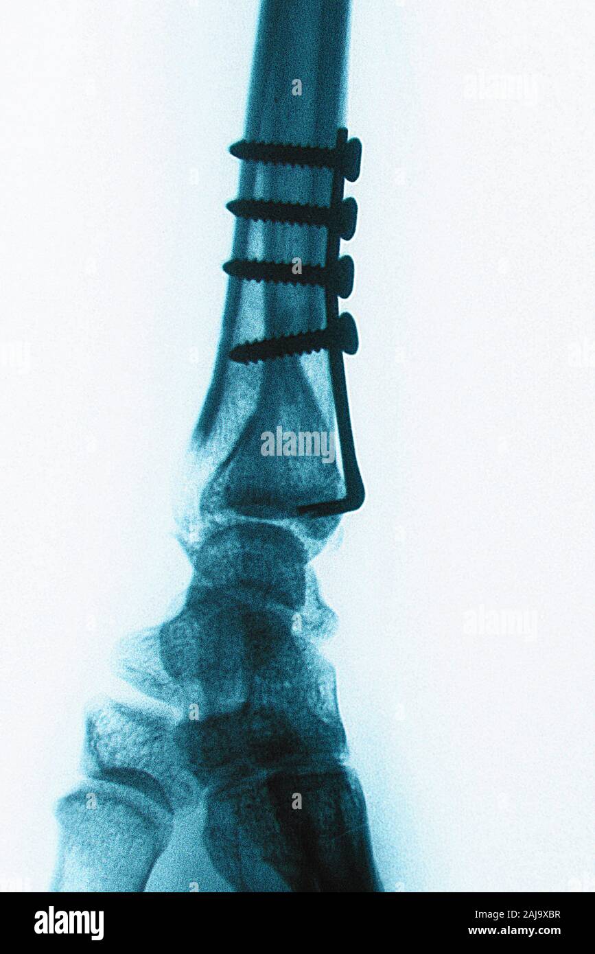 alamy stock photo bones of forearm alamy stock photo bones of forearm