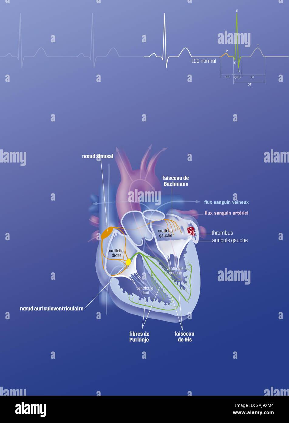 Atrial fibrillation Stock Photo