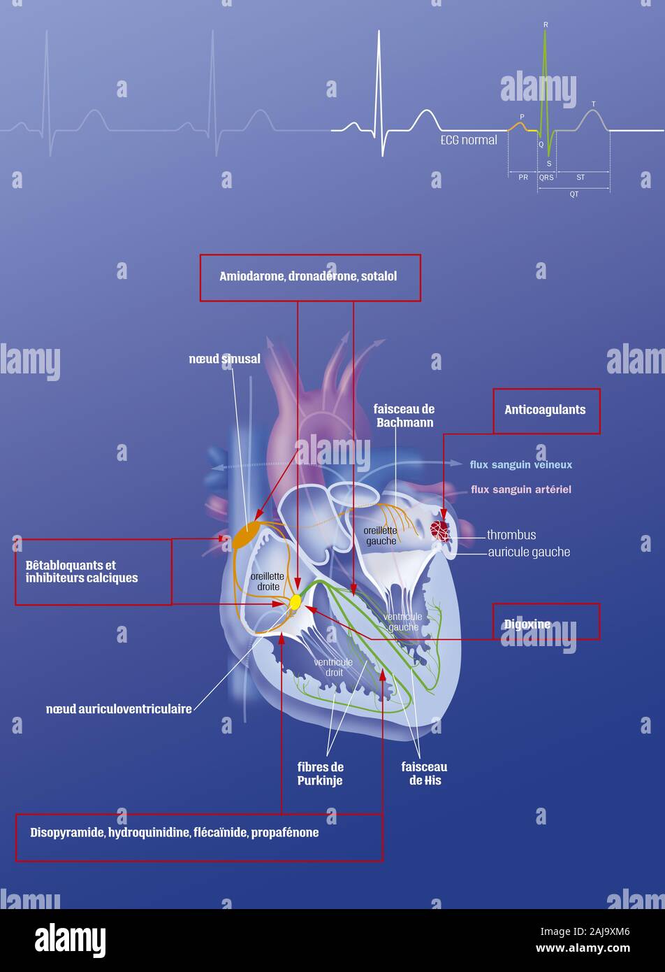 Atrial fibrillation and treatments Stock Photo