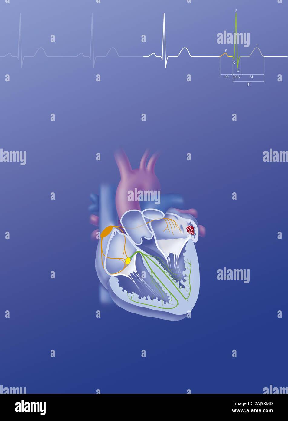 Atrial fibrillation Stock Photo