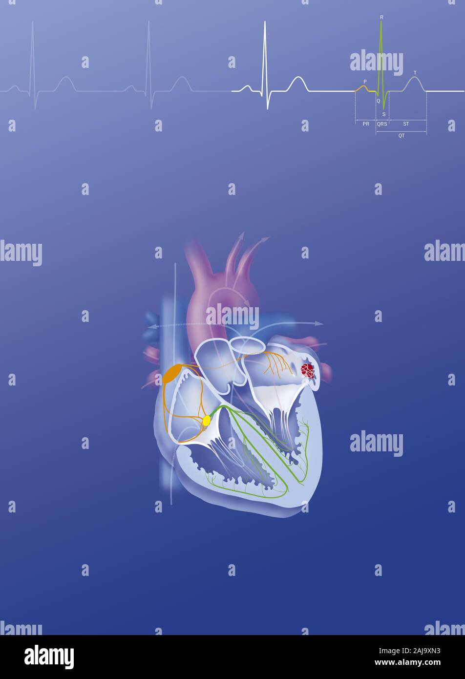 Atrial fibrillation Stock Photo
