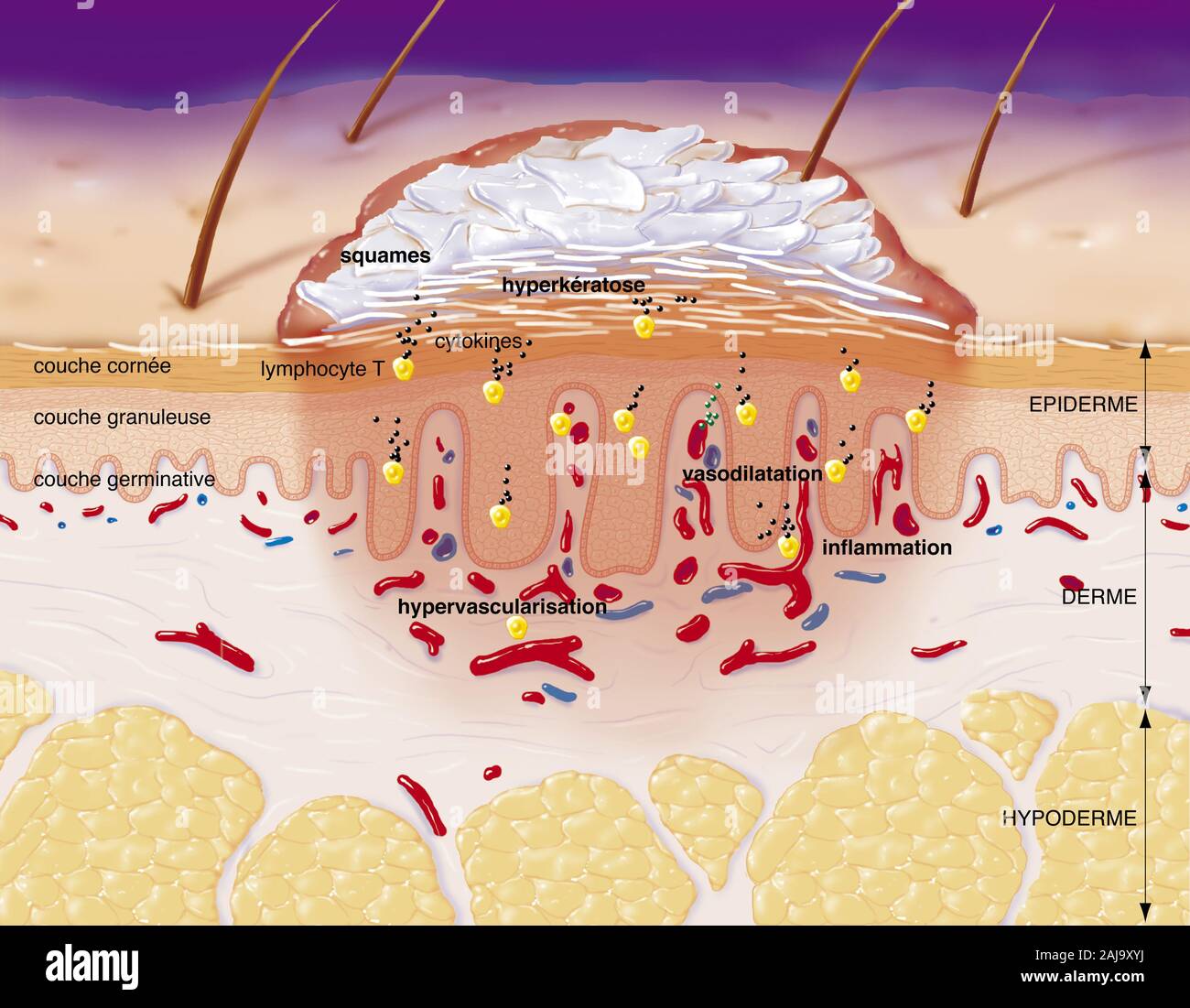 Sectional psoriasis, erythematosquamous plaque, hyperkeratosis, hyper