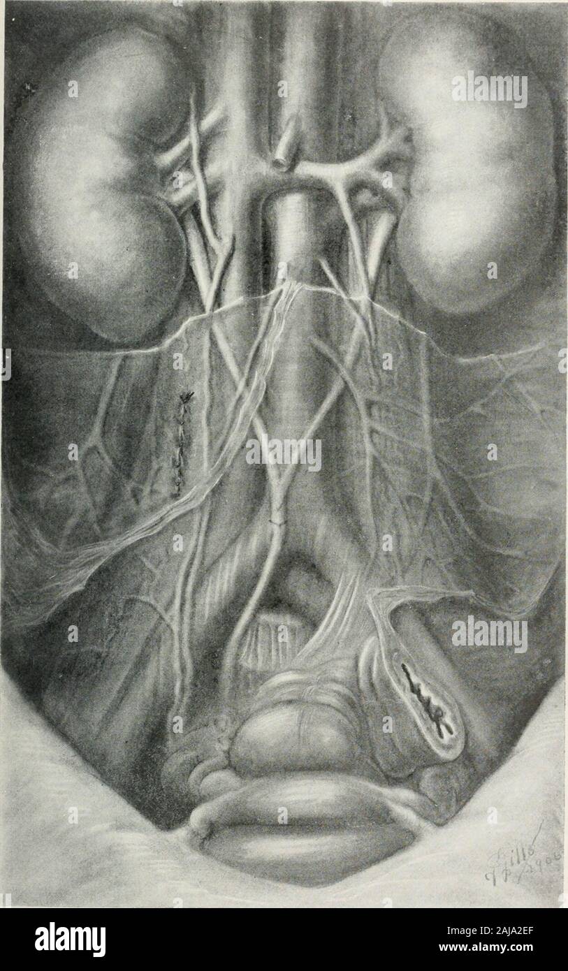 Annals of surgery . tudinal incision through the peritoneum over the rightureter, and its isolation, above the promontory of the sacrum, were made.Retracting the ureter laterally, a retroperitoneal dissection, largely bj thefinger, but assisted occasionally by the handle of a scalpel, was madetoward the mid-line, penetrating in the layer of connective tissue betweenthe inferior vena cava and aorta posteriorly and the peritoneum anteriorly,until the left ureter was reached and identified. After liberating this fora sufficient distance it was brought across to its fellow, incised, the distalextr Stock Photo
