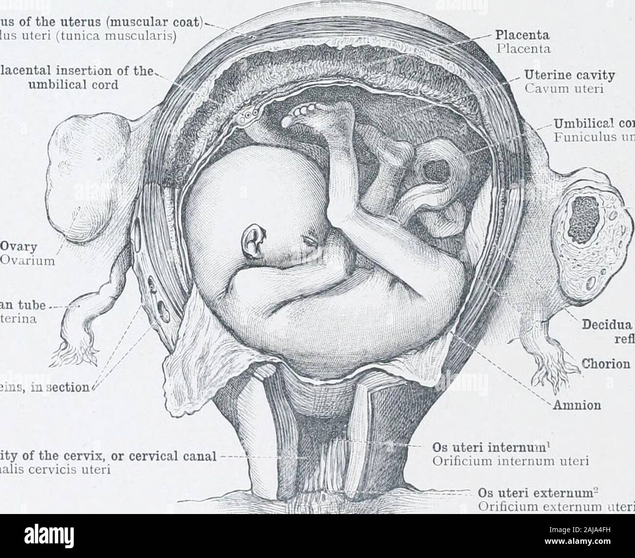 An atlas of human anatomy for students and physicians . Yolk sac (umbilical vesicle)Amnion Fallopian tube Tuba uterina (Falloppii) Neck of the uterus or cervix uteri Uterine cavityCa um uteri Embryo Os uteri internumOrificuim internum uteri Cavity of the cervix, or cervical canal ( analis cerMcis uteri Os uteri extemum- Orificium externum uteri Fig. 890.—Uterus in the Fifth Week of Pregnancy, opened from Behind. By the reniov.il of parts of the membranes the cavity of the amnion has been opened. Fundus of the uterus (muscular coat)Fundus uteri (tunica musculaiis) Placental insertion of the.,u Stock Photo