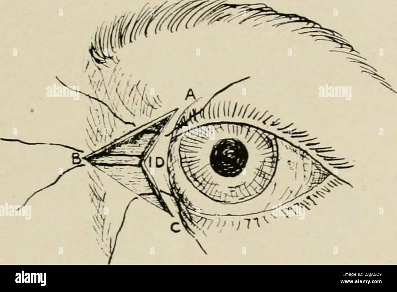 Plastic surgery; its principles and practice . Fig. 371.—Knapps operation (modified v. Ammon) for epicanthus.—An ellipse ordiamond-shaped piece of skin is excised from the bridge of the nose. The skin is under-mined and the edges are closed.. Fig. 372.—Operation for epicanthus (Berger).—An incision is made from the upper,and also the lower parts of the fold, to a point on the nose in line with the inner canthus,thus making a V-incision. From the ends of this incision two others are made which con-verge at a greater angle than the preceding, thus marking out the area ABCD, which isexcised. The Stock Photo