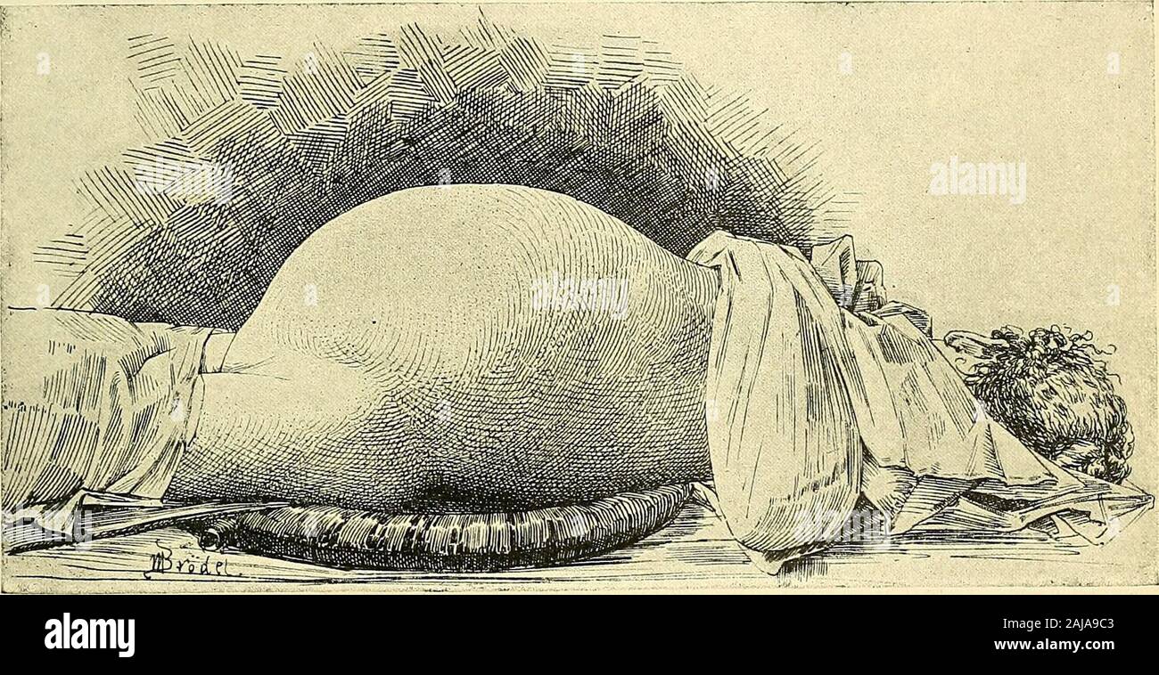 Fluid in abdomen hi-res stock photography and images - Alamy
