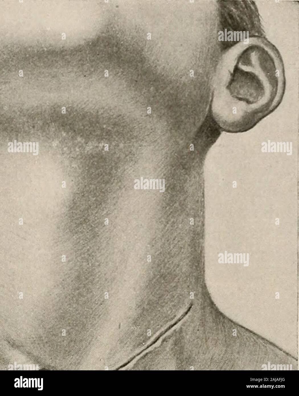 Surgical treatment; a practical treatise on the therapy of surgical diseases for the use of practitioners and students of surgery . Fig. 10S2.—Operation for Goiter. Operation completed. The divided muscles have been sewed, a drain has been placed, and the wound closed with subcuticular suture. STE^NO-THYRJDIPM/ STERNO-HYOID3^ ?£3mA 0i Stock Photo