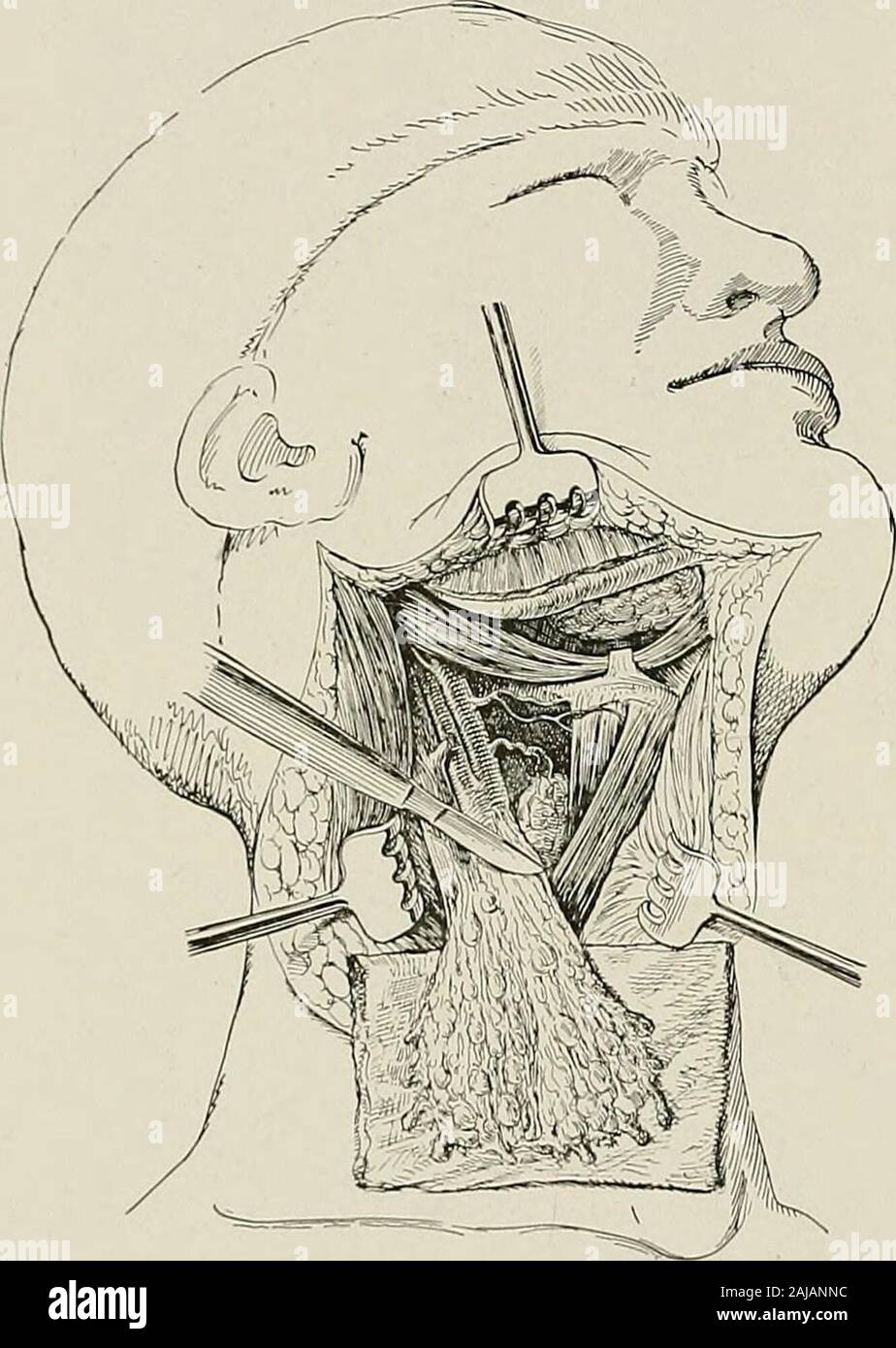 Surgical treatment; a practical treatise on the therapy of surgical diseases for the use of practitioners and students of surgery . they should be excised.Such excision may involve not only the internal jugular vein, but the carotidand vagus nerve as well. Operations on the Tonsil and Pharynx Through the Neck.—Tumors ofthe tonsil, pharynx and the adjacent regions may be reached by operation 368 5 URGICA L TREA TMEN T laterally through the neck, called lateral pharyngotomy. An incision ismade along the upper half of the anterior border of the sternomastoid muscle.A second incision is carried fo Stock Photo