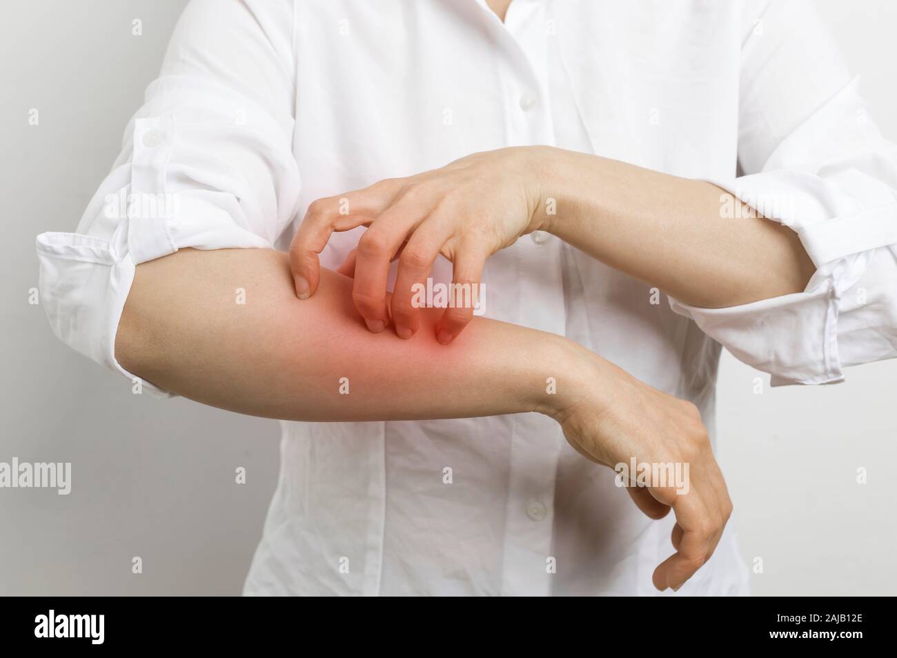 Scabies Rash High Resolution Stock Photography And Images Alamy