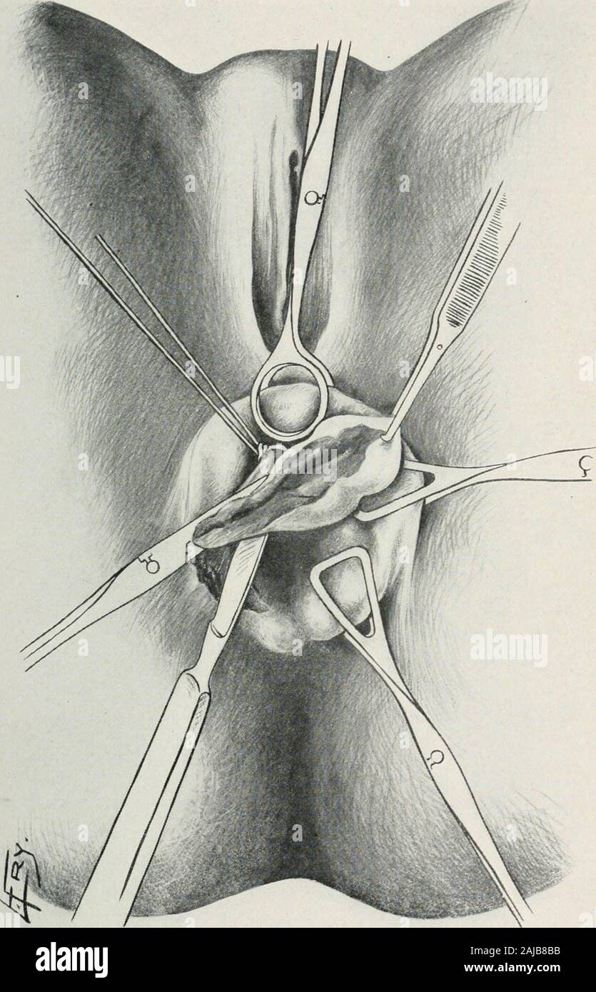 Annals of surgery . he tissues underneath the arms of the clamptwo, three or four times, as the extent of the disease mayseem to require, until all of the tissues grasped by the clamphave been included. (Fig. 7.) The clamp is now loosened byslight manipulation, and withdrawn, after which the liga-ture is drawn up tight, by which maneuver the entire siteof the pile is included in the line of suture down to the pointof the mucocutaneous junction. If the incision has been at all extensive, it is well toknot it here and suture the skin incision outward by aseparate line of suturing. In the less ex Stock Photo