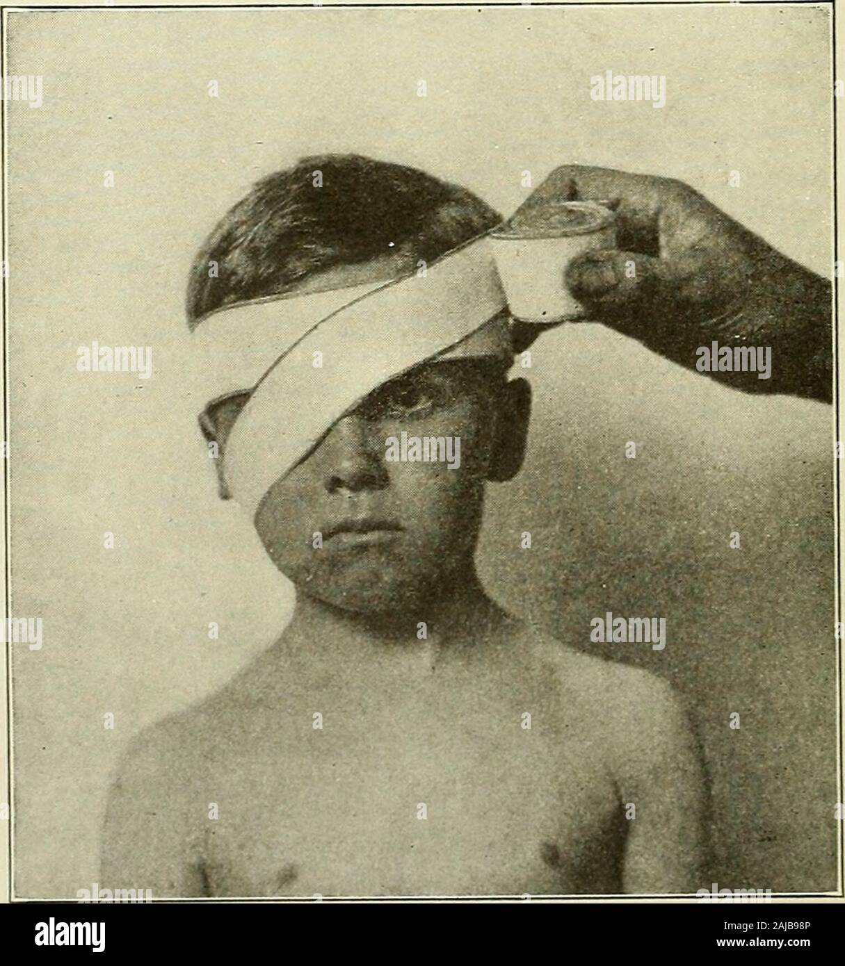 Preparatory and after treatment in operative cases . Fig. 247.—Dressing for Wounds of FaceAbove Nostrils. (Gerster.) dage should be made of oneand a half inch material.Gauze is used for the pur-pose because it is more pli-able than linen and will con-form more readily to theirregular outline of the parts.Wounds of the face healrapidly, the outcome of thevascularity of the part, and,perhaps, also because of thepresence in large quantity ofglandular elements in thissituation, resembling, inthese regards, the scalp.The suture material best em-ployed in this portion of thebody is horsehair or fine Stock Photo