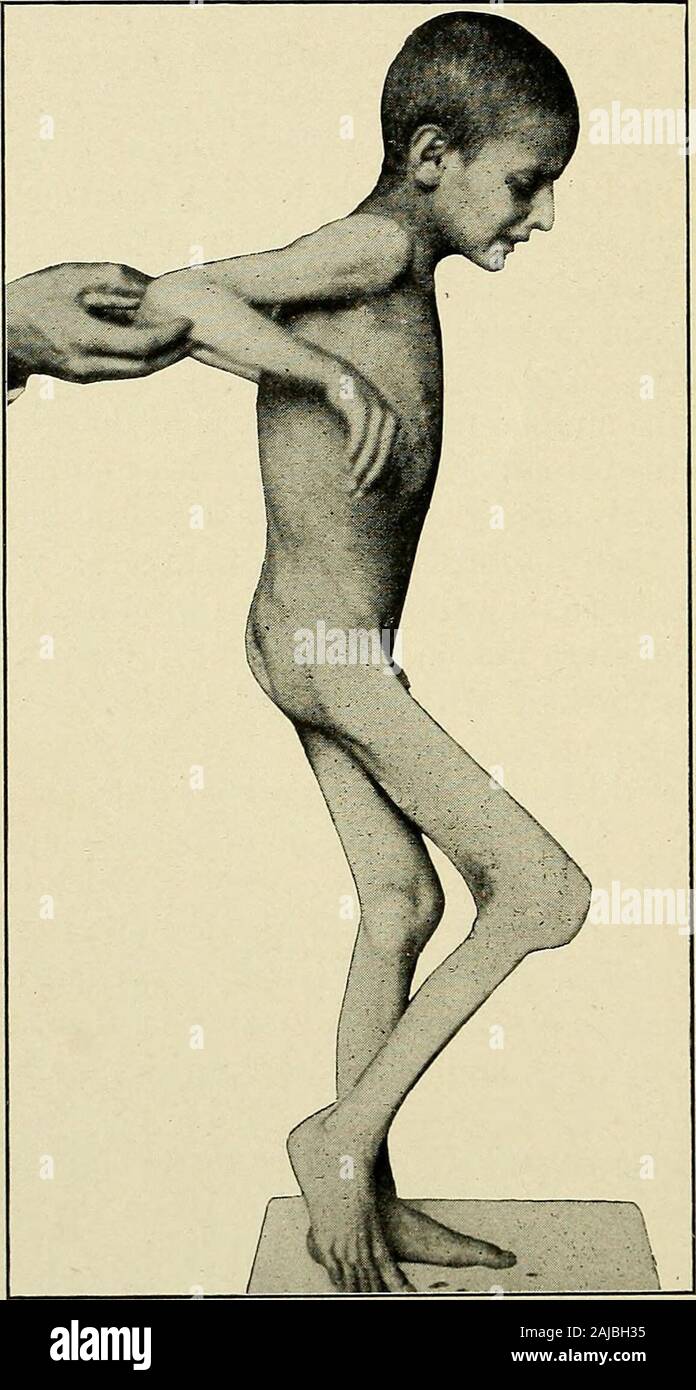 A treatise on orthopedic surgery . das in talipes due to absence