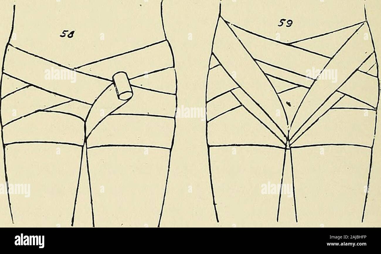The principles and practice of bandaging by Gwilym G Davis . Two ways