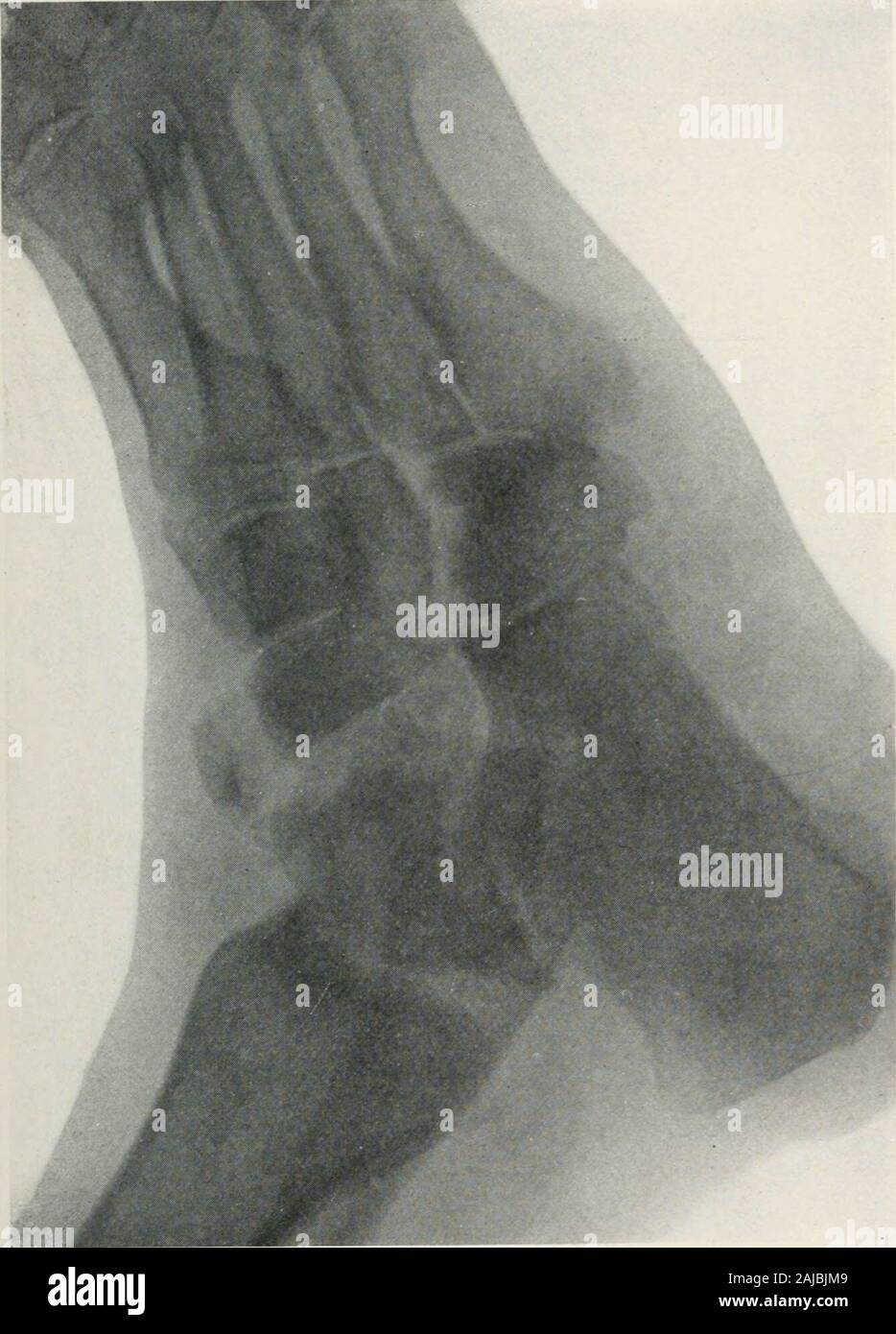 Tabes dorsalis hires stock photography and images Alamy