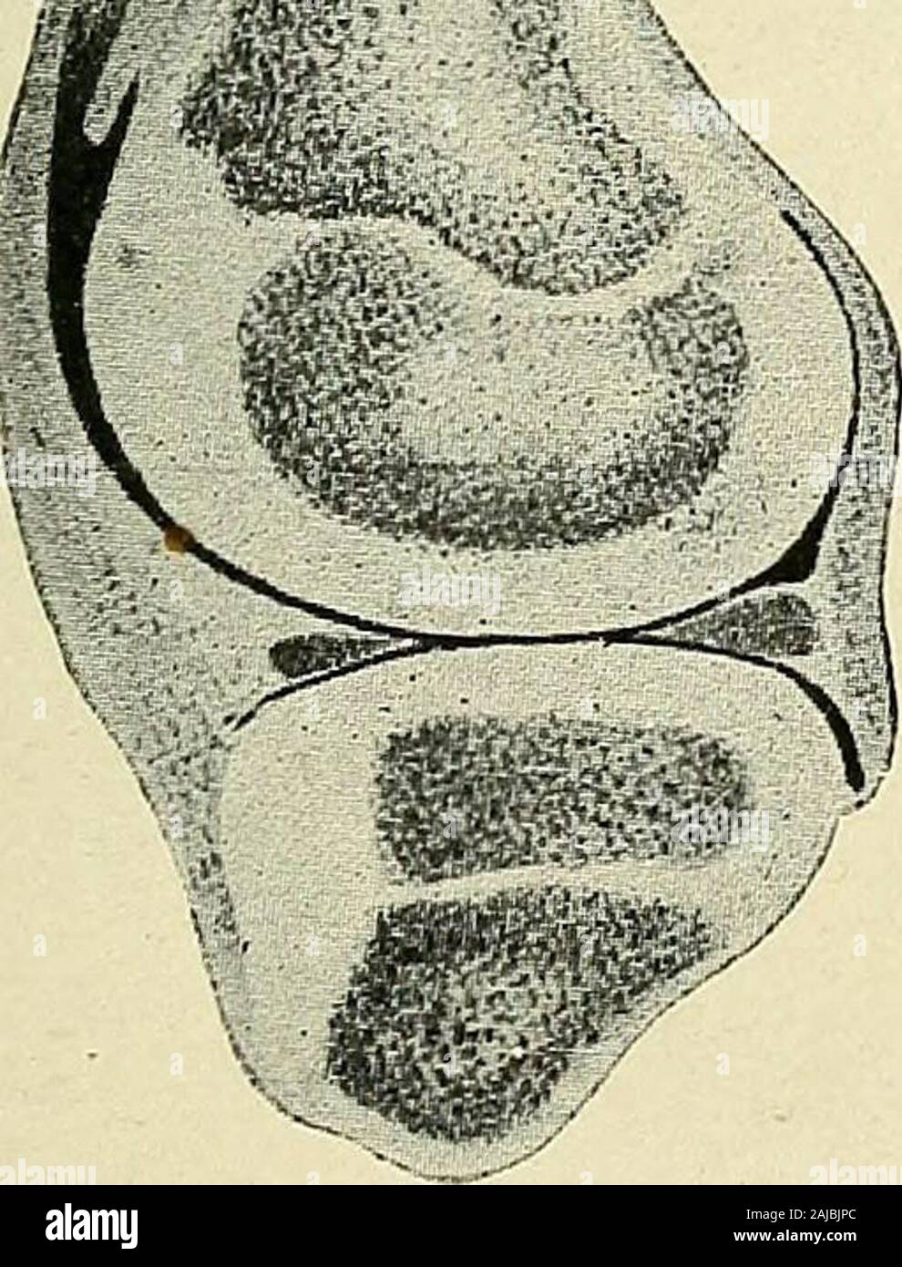 A treatise on orthopedic surgery . joint in which movement causes pain