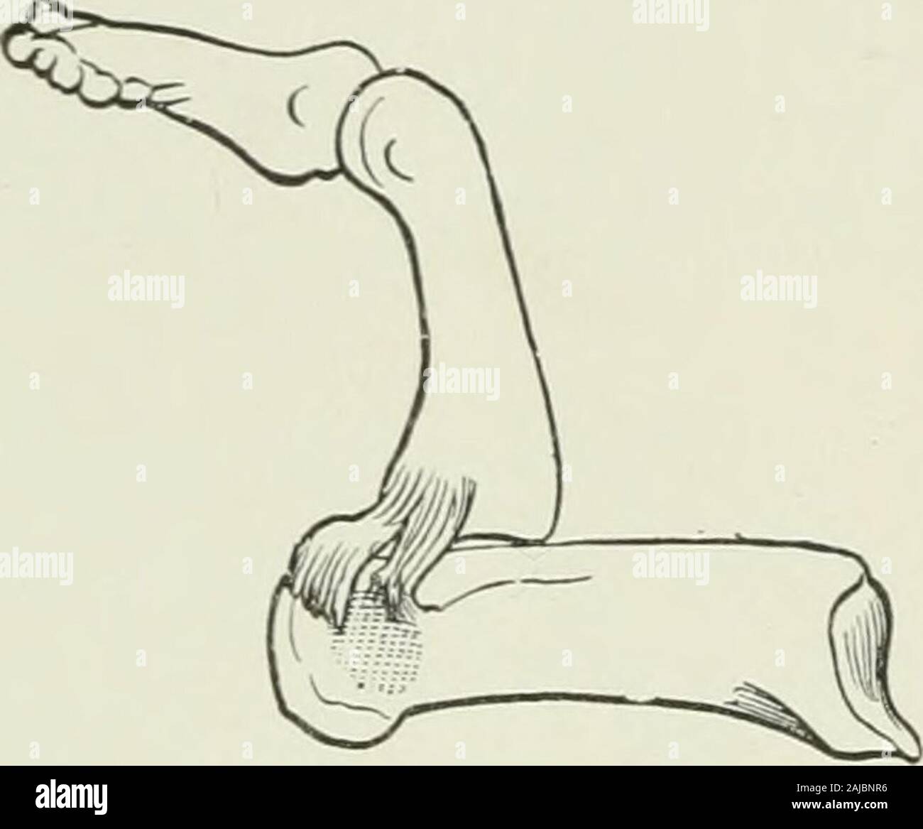 Thumb dislocation hi-res stock photography and images - Alamy