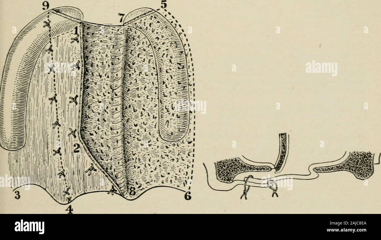 Plastic surgery; its principles and practice . Fig. 254.—Lanes ...