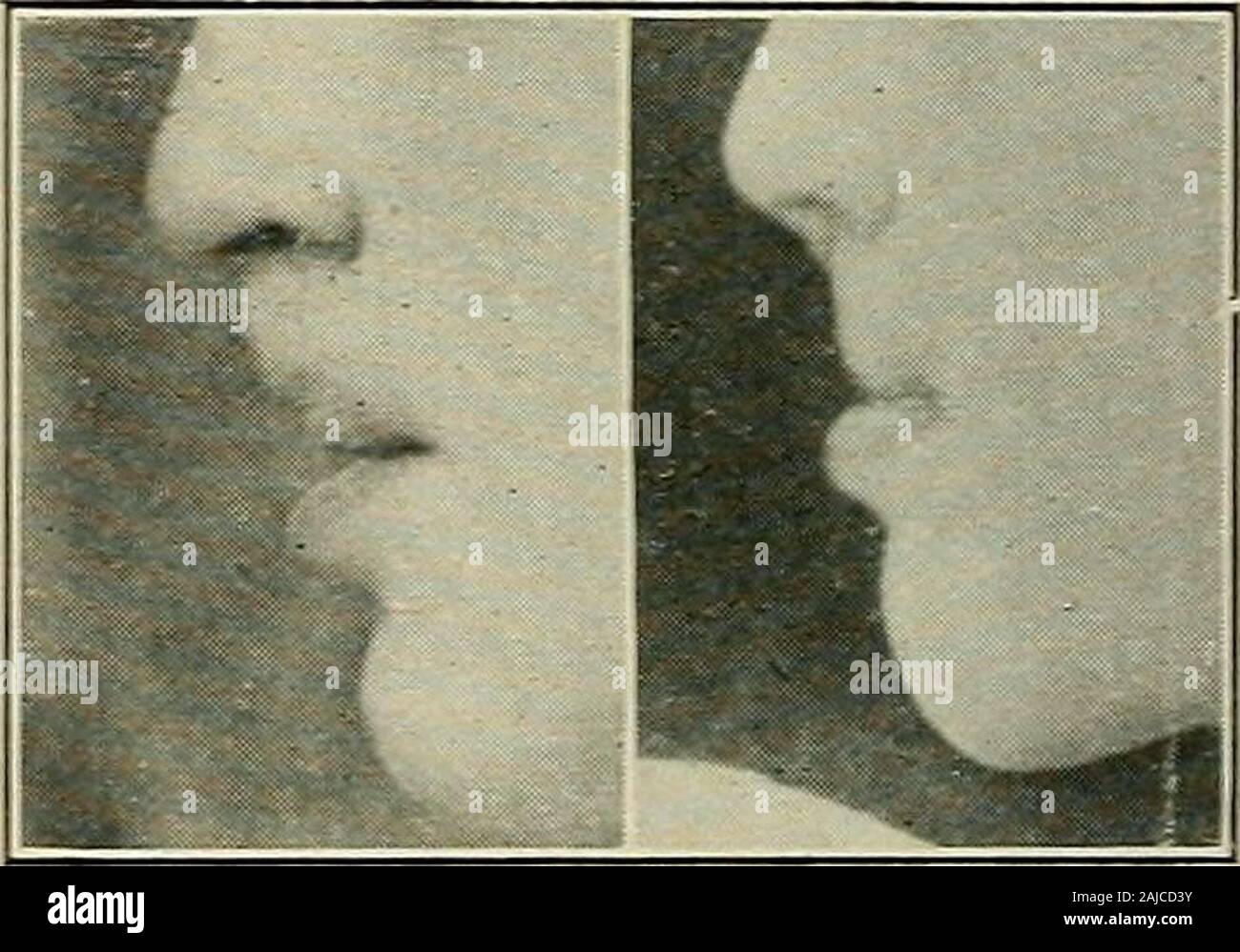 Complete cleft palate hi-res stock photography and images - Alamy