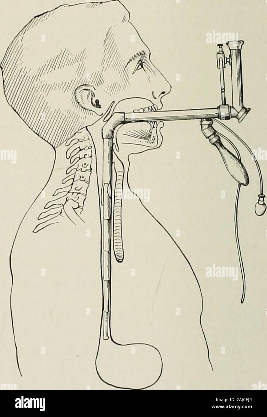 Surgical treatment; a practical treatise on the therapy of surgical diseases for the use of practitioners and students of surgery . Fig. 902.—Esophagoscope. The telescoping instrument of Lewisohn. Fig. 903.—Esophagoscope. Telescoping instrument released and tube extended to stomach. to slip a snare over an open safety pin and close it before attempting itsremoval. This has been successfully done. A magnet on the end of a rodmay be used to remove iron bodies. THE MOUTH Two peculiarities of the oral cavity are of moment in the treatment of itsinjuries and diseases: asepsis can not be attained; a Stock Photo