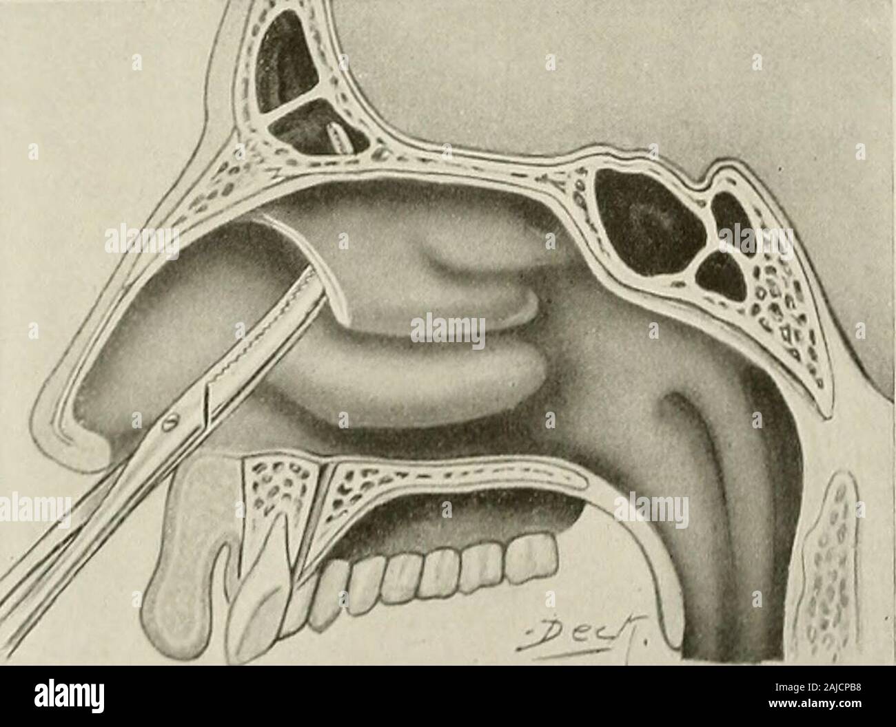 Surgical treatment; a practical treatise on the therapy of surgical diseases for the use of practitioners and students of surgery . Fig. 864.—Nasal Approach to Frontal Sinus. The anterior end of the middle turbinate has been removed, and the forceps are cutting away the anterior ethmoidal cells. outer margins of the orbit inward along the upper margin to the root of thenose, lying wholly in the area of the eyebrow. The incision then passesdownward upon the nasal process of the superior maxilla, following themargin of the orbit, and curves outward to end below the inner canthus. Fig. 865.—Nasal Stock Photo