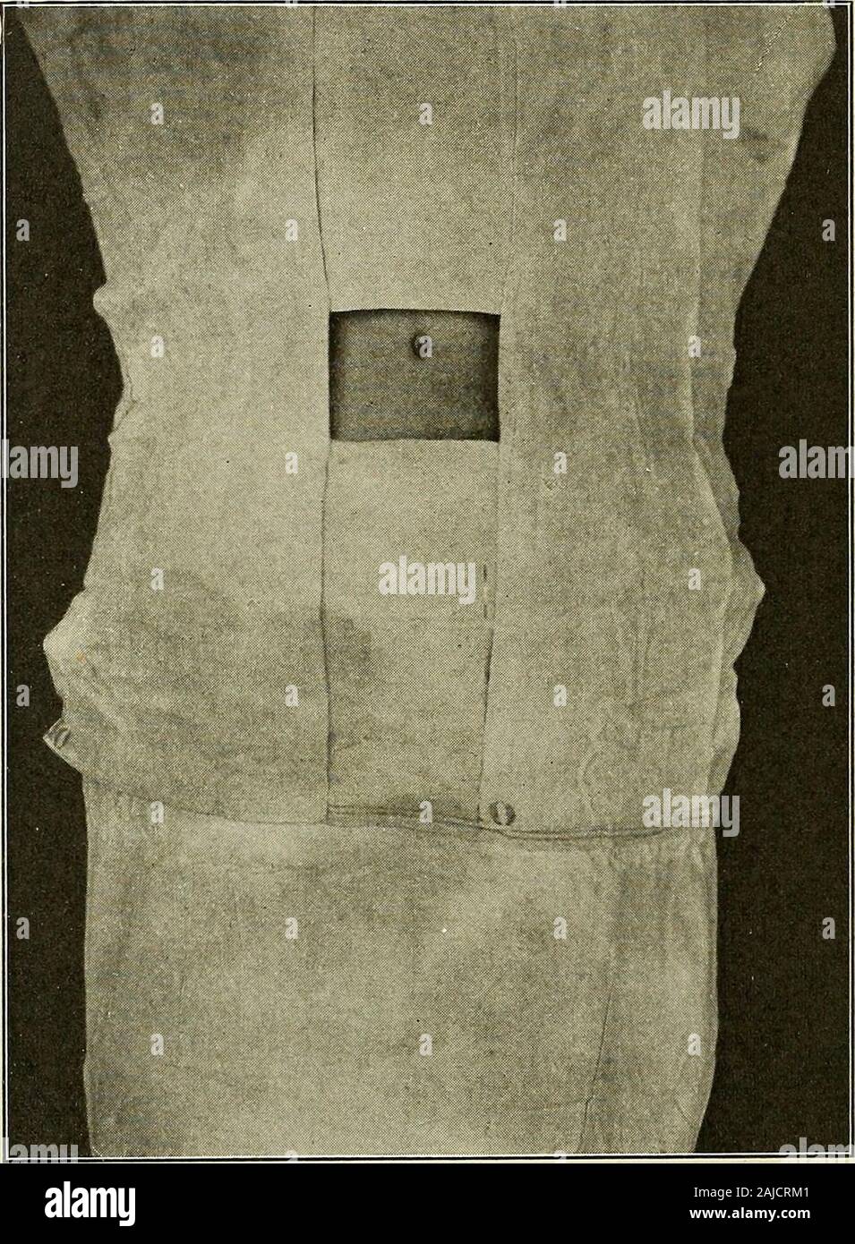 Preparatory and after treatment in operative cases . Fig. 122.—Sterile Towels Arranged inManner to Surround Operative Field. THE OPERATING ROOM IN PRIVATE PRACTICE Using the description of the operating room as described as astandard, as nearly as possible an arrangement should be attemptedwhen operating in private practice. As already stated, sterile 170 THE OPERATING ROOM material for wipes, dressings, sterile towels and dressings areobtainable in the market, packed in impervious packages, whichsimplifies very much the problem. If the surgeon have not at hiscommand apparatus which will steri Stock Photo