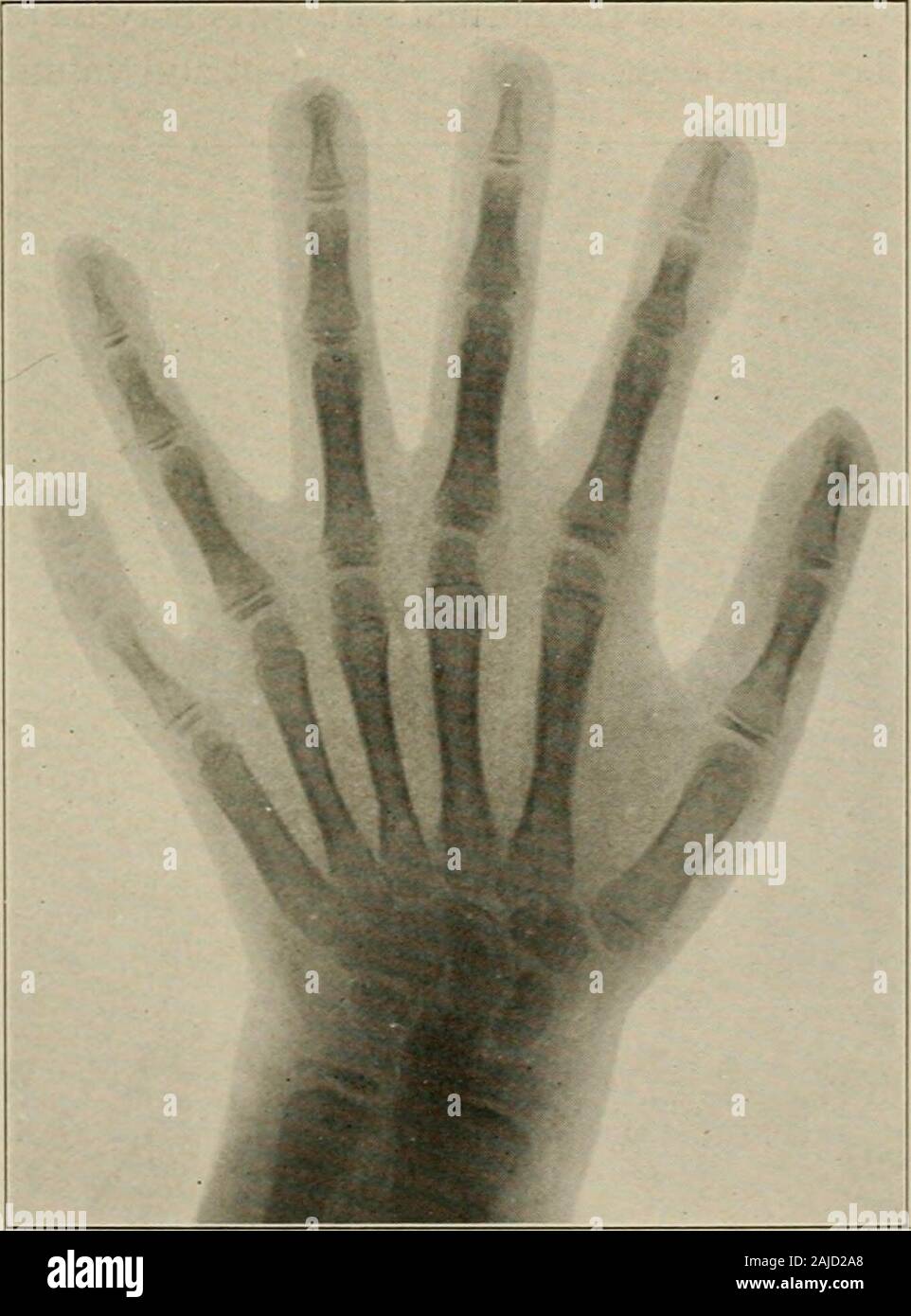 Plastic surgery; its principles and practice . Fig. 183 .—Supernumerarythumb.—Amputation with propertrimming of the projecting articu-lation was done. Fig. 184.—Polydactylism. (X-ray Xo.35961).—Double little toe.. Fig. 185.—Polydactylism. (A-ray No. 22252).—Five fingers and a thumb, all of which functionate normally. ^ 236 PLASTIC SURGERY The deformity may be unilateral or bilateral, or the hand and footon the same side may be involved. As many as 13 fingers on each handand 12 toes on each foot have been reported. The fifth finger is mostoften double. Stock Photo
