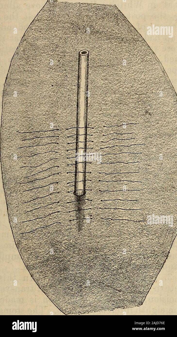 The Medical and surgical reporter . catheter scale), was introduced into thestomach and infolded by two rows ofLembert sutures, after Witzels method. ternal end emerging near the median Ime.Three stitches were now inserted into thewalls of the stomach but not tied before December 16, 1893. Original Articles. 925 it was returned to the abdomen, theirneedles being left threaded. As soon asthe stomach was returned these needles. Fig. 2.—Witzels method for Gastrostomy, showingapplication of sutures in wall of stomach embedding tube?obliquely therein. were thrust through the abdominal walland the s Stock Photo