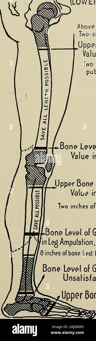 Private Charles Myer, Amputation of the Right Thigh, from the Photographic  Catalogue of the Surgical Section