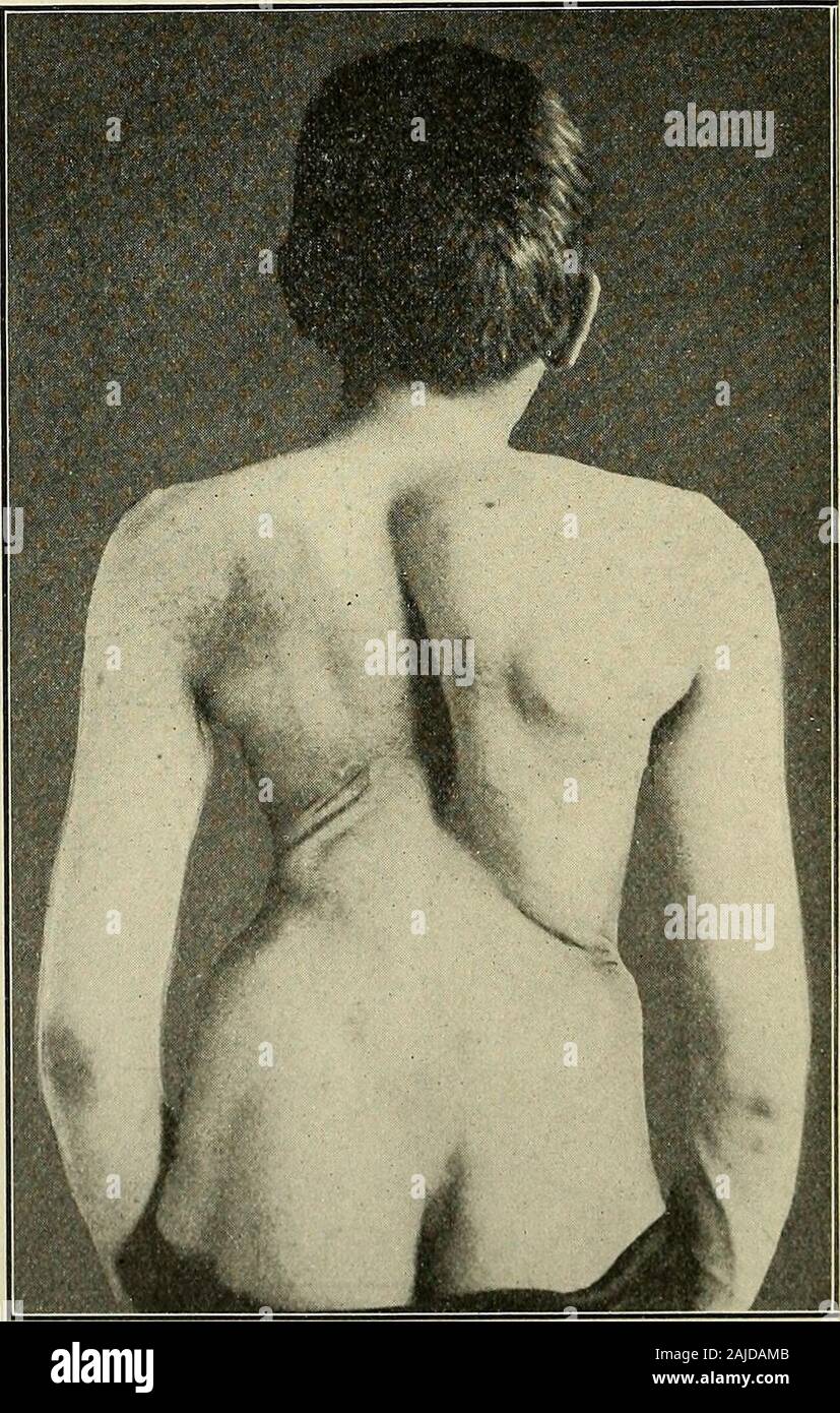 A treatise on orthopedic surgery . 23. The same position. Alternately and forcibly flexingthe thighs and legs, causing the knees to touch the shoulders.Ten to twenty times (Fig. 137). Fig. 141.. Scoliosis of an advanced type accompanied by dyspnoea and cyanosis. (Teschner.) LATEEAL CUEVATUBE OF THE SPINE. 195 24. The same position as in No. 21, extending the rightlower extremity, the right bell inside the thigh, the right footmoved in a circle on a horizontal plane to complete extension Fig. 142. Stock Photo