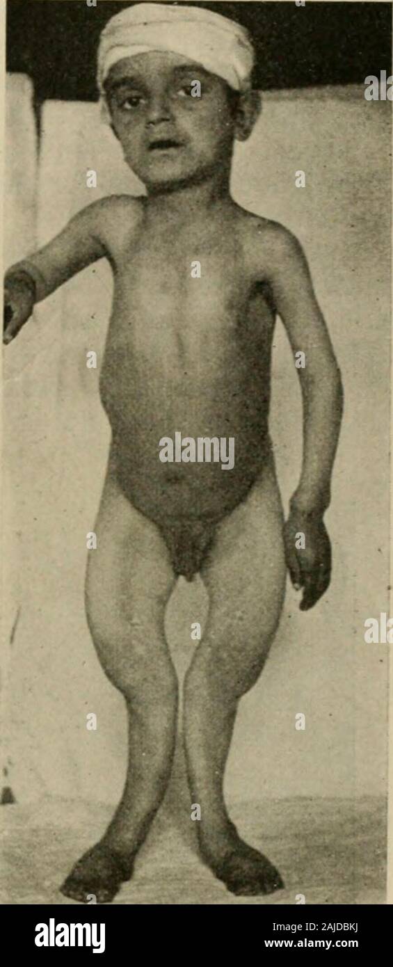 The diseases of infants and children . Fig. 205. Vu:.  UG. Fig. 205.—Rachitic Spinal Curvature. Sam# case as in Fig. 204. Very decided diminution in the degree of curvature whenthe child is suspended. Courtesy of Dr. H. R. Wharton. Fig. 206.—Severe Case of Rickets.Illustrates the enlargement of the wrists and the curvature of the legs. Courtesy ofDr. H. R. Wharton. Stock Photo