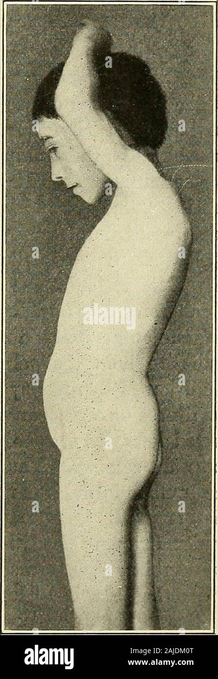 A treatise on orthopedic surgery . das in talipes due to absence