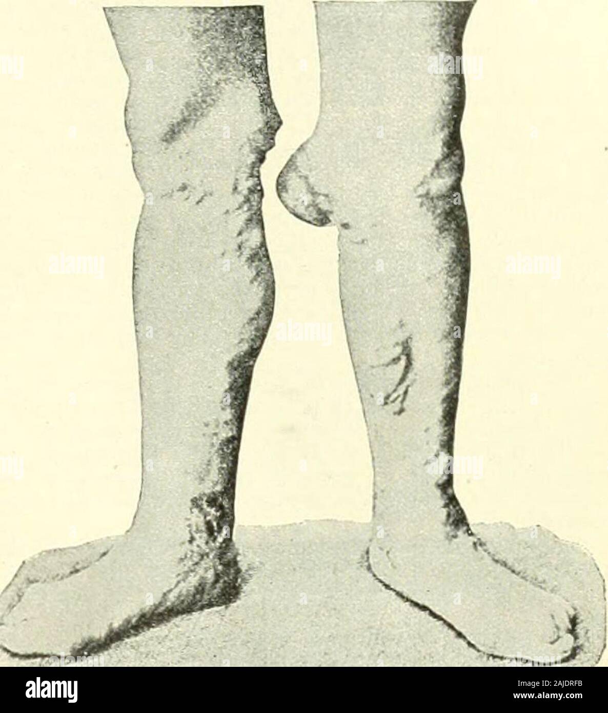 A Reference handbook of the medical sciences embracing the entire range of scientific and practical medicine and allied science . ose is to be attributed to such varicosity. A long-standing ulcer of the leg of a non-malignant, non-syph-ilitic, non-tuberculous character is better spoken of as achronic ulcer. It may be the direct or indirect result ofvaricose veins, but it may also be due to traumatism oreczema, or cedema, or aniemia. It is misleading to callall such ulcers varicose ulcers. Thej- are all due to poorlocal nutrition, of which varicosity of the veins is sim-jily one cause. When var Stock Photo