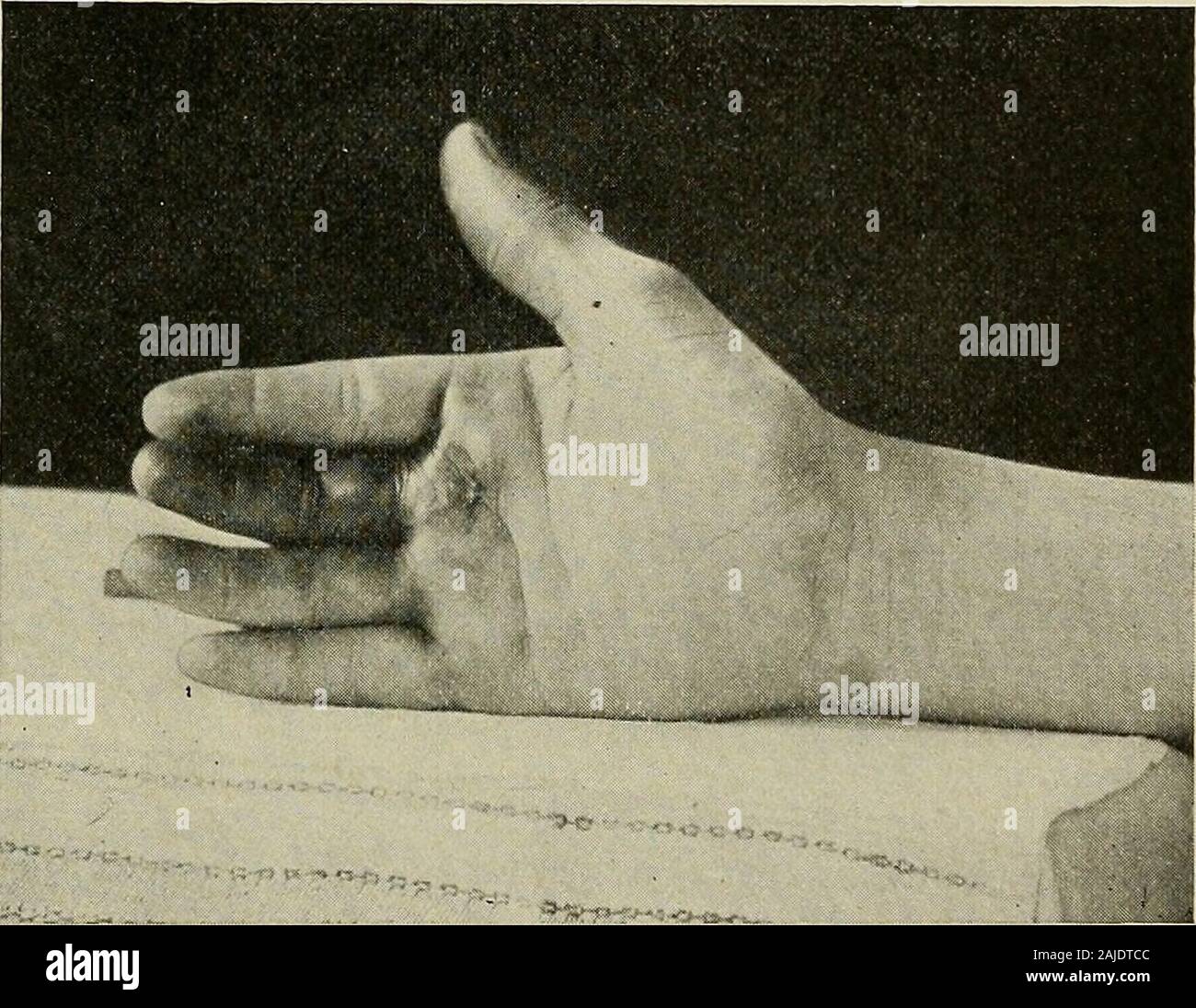 Industrial medicine and surgery . spoints on the hand, tends to spread