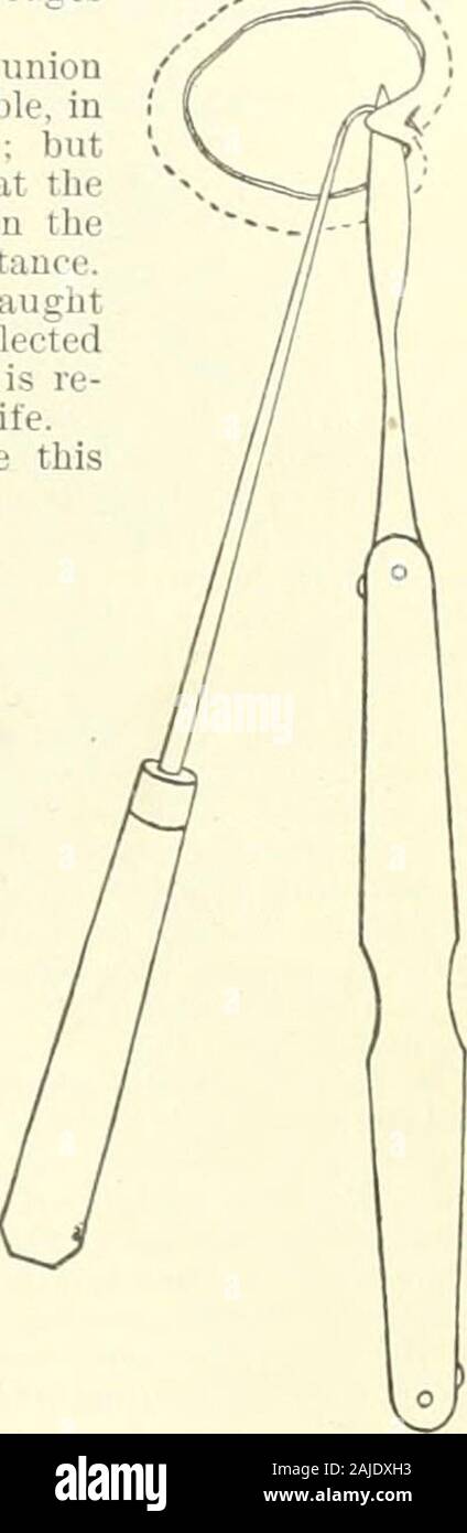 A Reference handbook of the medical sciences embracing the entire range of scientific and practical medicine and allied science . FIG. 4955.—Dpmidlng withScissors.. Fig. 4956.—Denuding with Knife. Fig. 49.54.—Sims Tampon Extractor, with closed and open screws. (Alter Mund^.) Sims speculum, long-handled left and right curvedscissors (Emmets cervix scissors are usually sufficient),a .long-handled knife with narrow blade, two or threetenacula, needles and needle-holder, counter-pressurehook and fork, twisted silk for carrying No. 37 or 28 strip of tissue encircle the entire fistula without cuttin Stock Photo