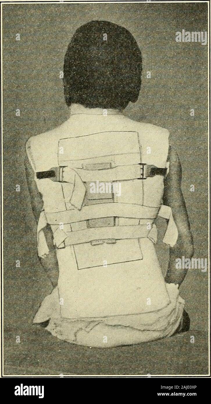 A treatise on orthopedic surgery . alot jacket showinghooks. the pad and In applying the support the patient is partly suspended inthe ordinary manner. If the head is to be included a specialsling must be used. This may be improvised from bandagematerial, but preferably it is made of canvas. It should beabout five to six feet in length and two and a half inches inwidth, the ends are sewed together making when it is passedover the cross bar, two loops, of which one is placed about the TUBERCULOUS DISEASE OF THE SPINE. 85 chin and the other beneath the occij)ut. These are attached toone another Stock Photo