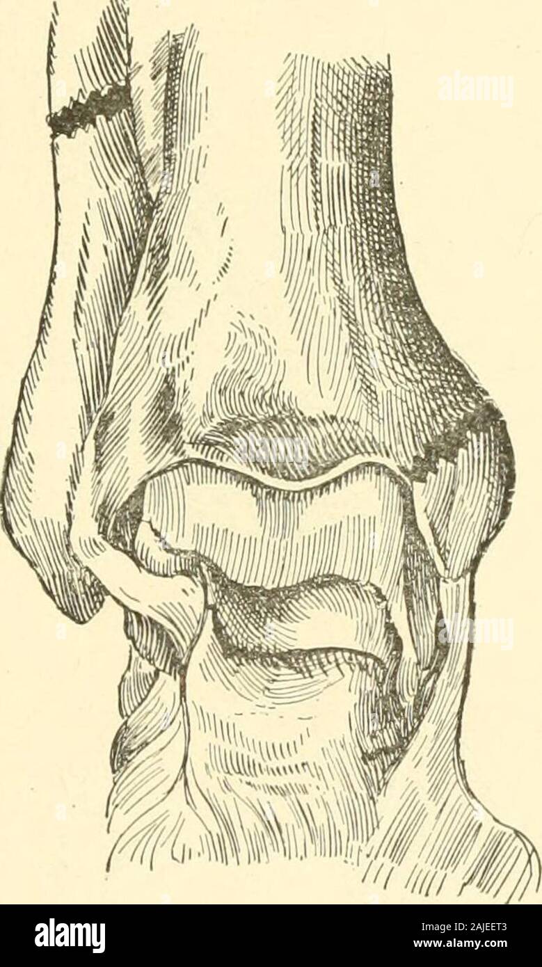 The treatment of fractures . mple steadyingapparatus, which makes no uneven or severe pres-sure, will serve, with the aid of the unbroken tibia, tohold the ends of the fracture quiet. Eeduction should be attempted by manipulation.Usually local manipulation will suffice to bring theends into fairly good apposition. Inward rotationor adduction of the foot will sometimes assist whenthe lcwer fragment is displaced inwards. As a rule, Fractures of the Uones of the Leg. 165 perfect apposition is not obtained and is not neces-sary. Ensheathing callus readily forms and de-formity rarely results, while Stock Photo