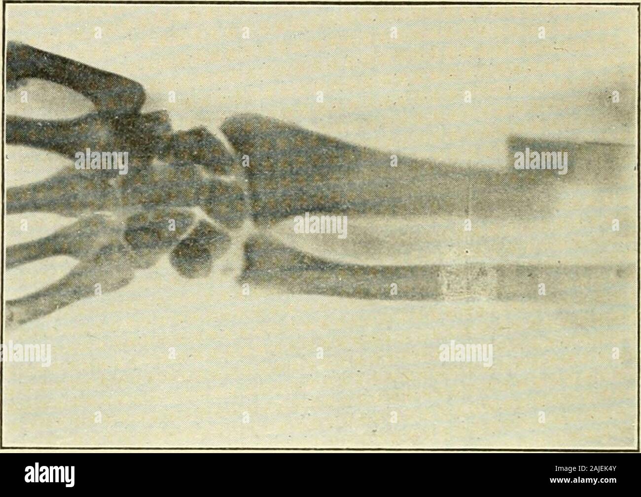 The treatment of fractures . Fig. 12. Fracture;of Shaft of Ulna
